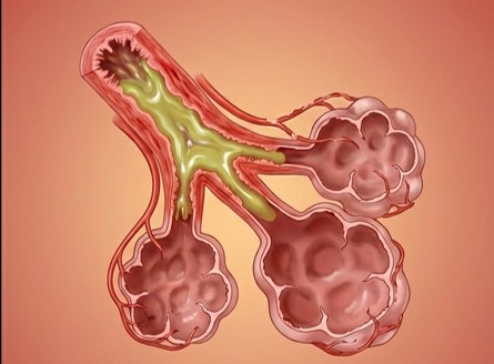 Imagem representa a bronquite crônica e o enfisema no doente com DPOC