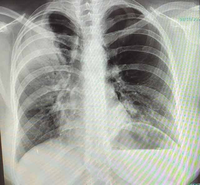 Raio x de tórax com pneumonia no ápice direito