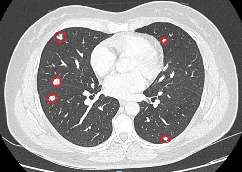 Tomografia de tórax com nódulos pulmonares